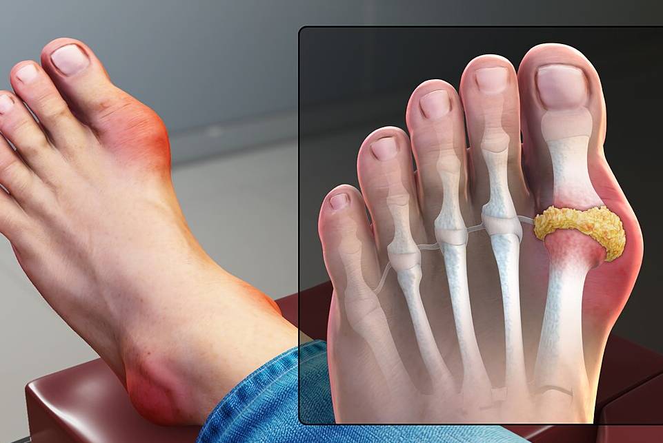 Gout relief IV