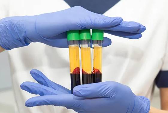 Platelet rich plasma